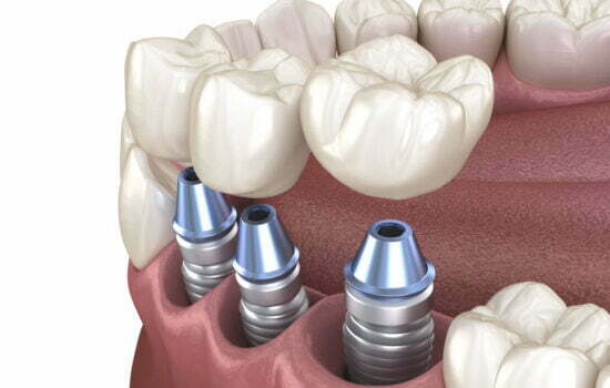 Dental Implants