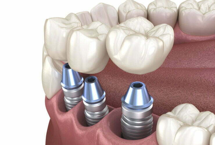 Dental Implants