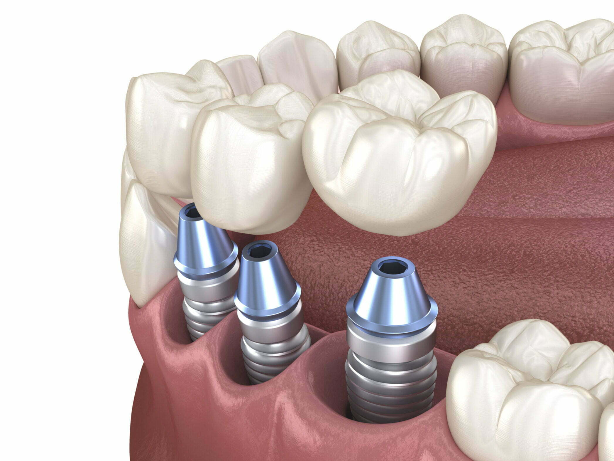 Dental Implants