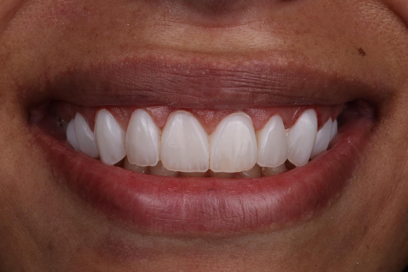10 layered composite veneers and gum lift by Dr Charles M Brandon