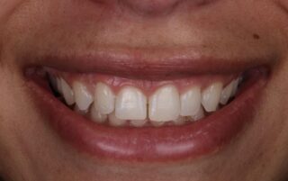Full smiling photo before 10 layered composite veneers by Dr Charles M Brandon