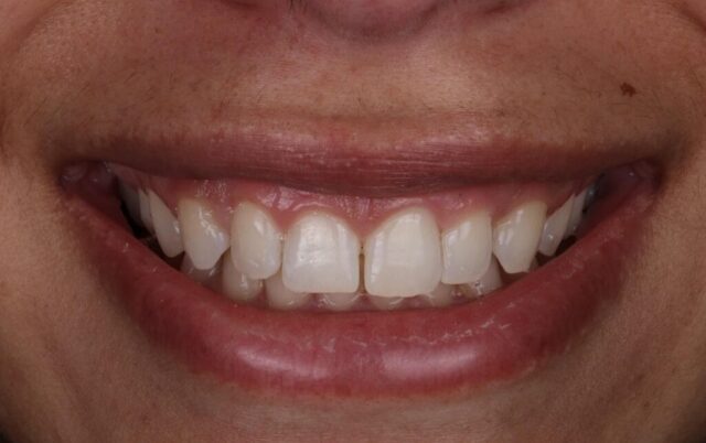 Full smiling photo before 10 layered composite veneers by Dr Charles M Brandon