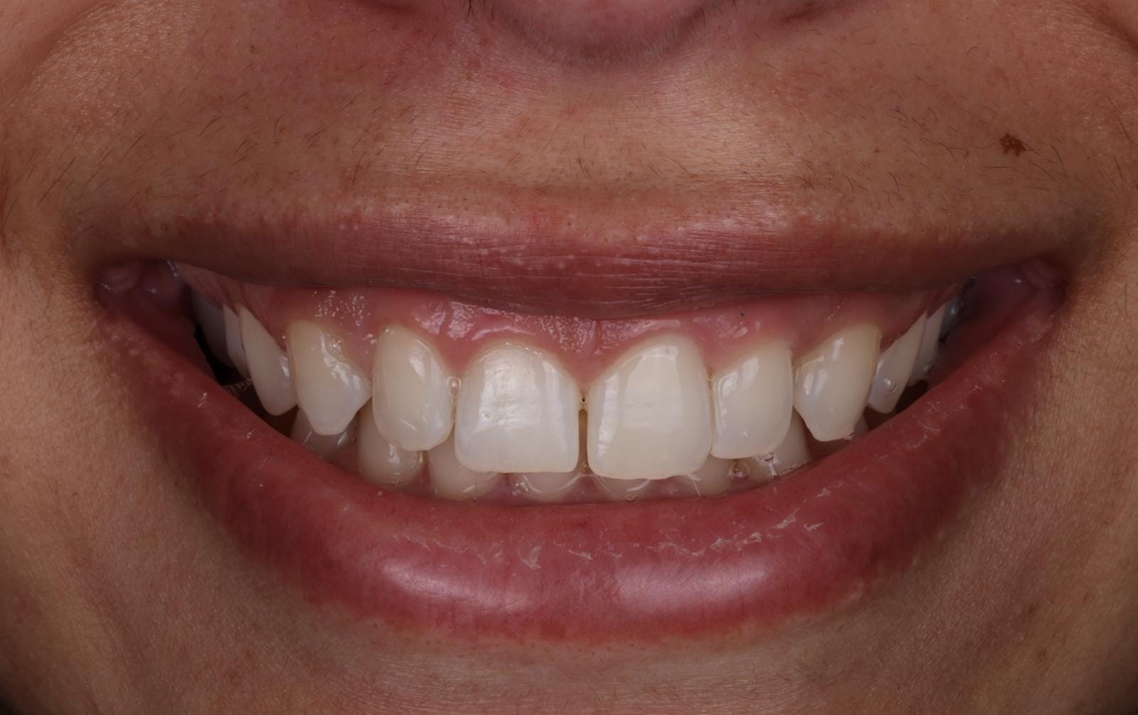 Full smiling photo before 10 layered composite veneers by Dr Charles M Brandon